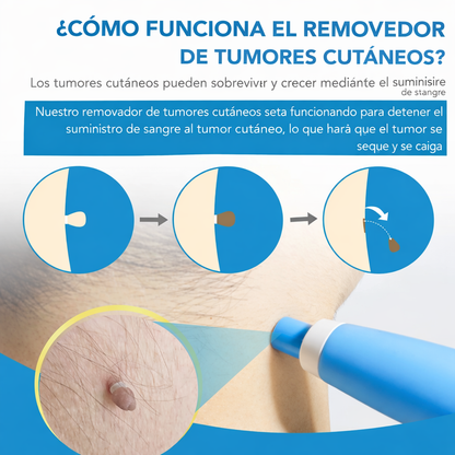 Kit eliminador de verrugas – elimínalas fácilmente desde casa sin complicaciones